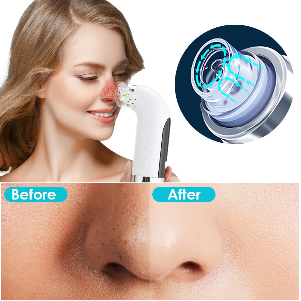 Blackhead Remover Nose T Zone Pore Vacuum Acne Pimple Removal Vacuum Suction Tool Facial Diamond Dermabrasion Machine Face Clean