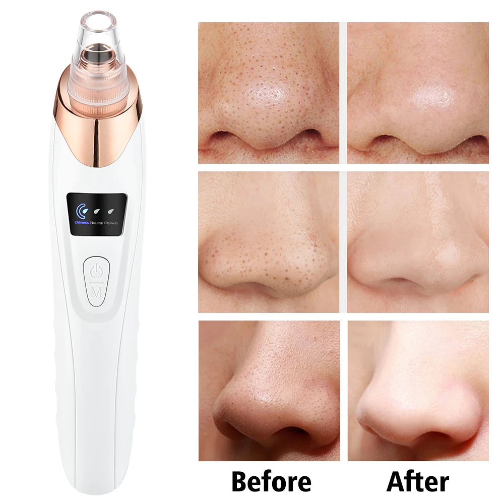 Blackhead Remover Nose T Zone Pore Vacuum Acne Pimple Removal Vacuum Suction Tool Facial Diamond Dermabrasion Machine Face Clean