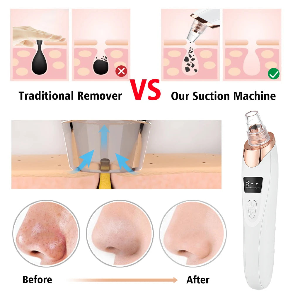 Blackhead Remover Nose T Zone Pore Vacuum Acne Pimple Removal Vacuum Suction Tool Facial Diamond Dermabrasion Machine Face Clean