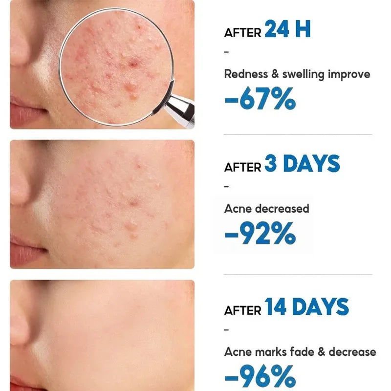 Salicylic Acid Acne Removal Cream Anti-Acne Repair Redness Pimple Spots Deep Cleaning Pore Oil Control Moisturizing Skin Care