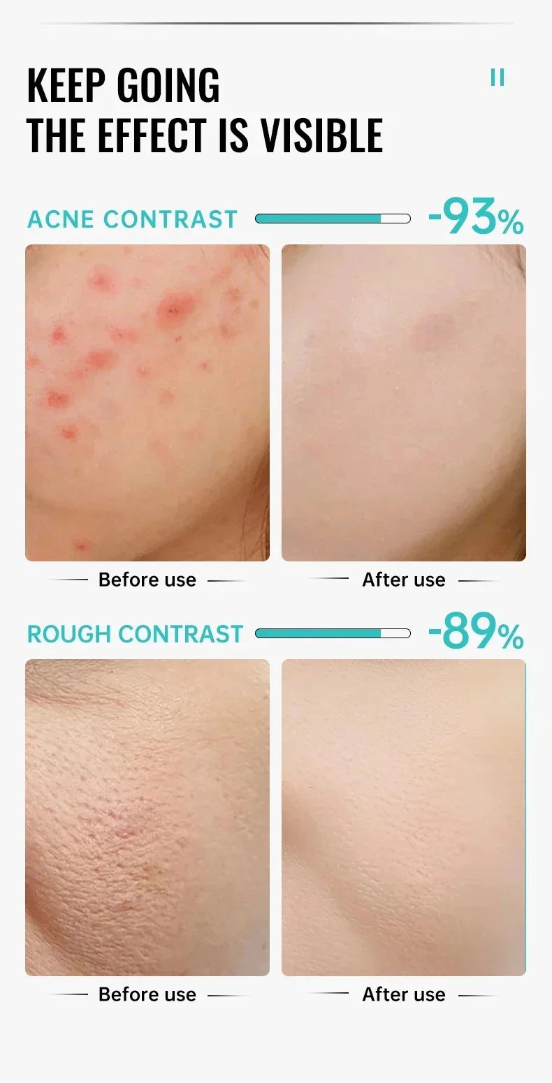 Salicylic Acid Acne Removal Cream Anti-Acne Repair Redness Pimple Spots Deep Cleaning Pore Oil Control Moisturizing Skin Care