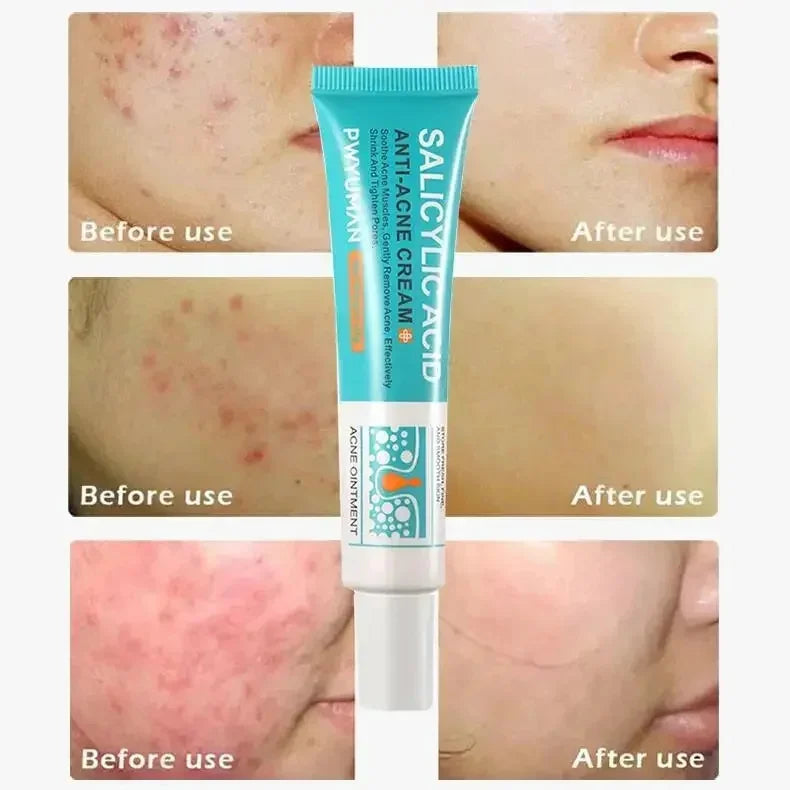 Salicylic Acid Acne Removal Cream Anti-Acne Repair Redness Pimple Spots Deep Cleaning Pore Oil Control Moisturizing Skin Care