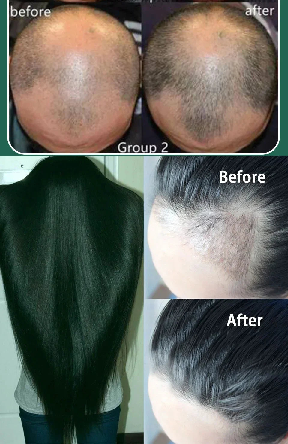 Hot selling product, 99% of buyers buy again, have more and more hair, say goodbye to baldness, thick hair