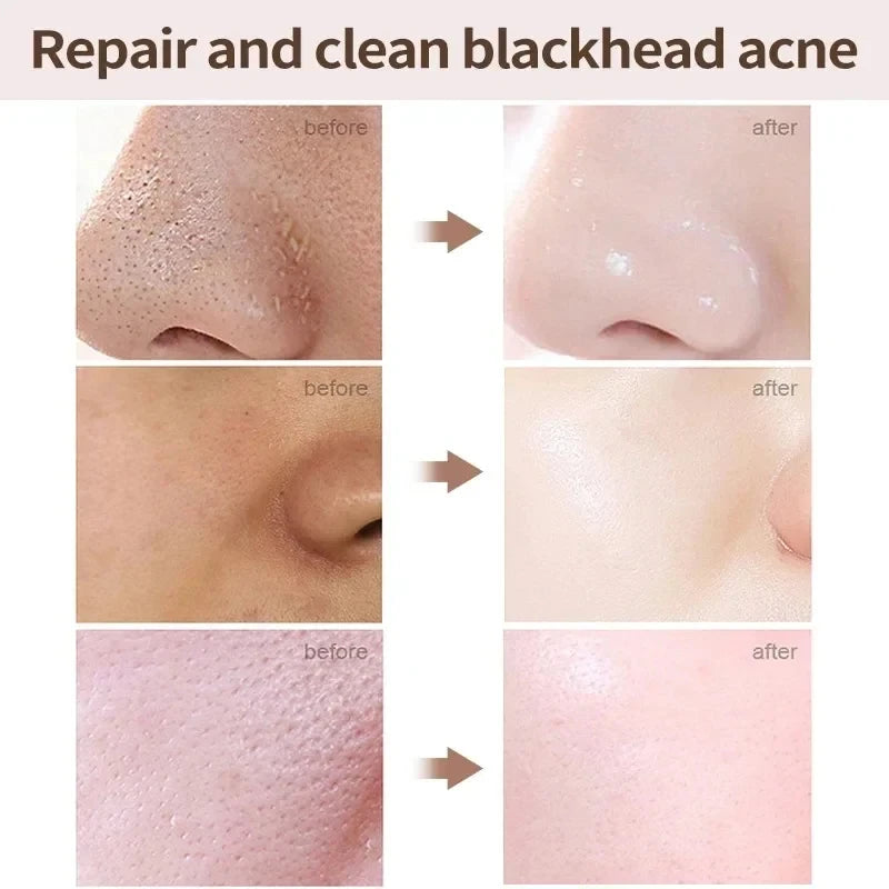 Salicylic Acid Pores Shrink Cream Refining Large Pore Improve Face Acnes Blackhead Remove Cream Anti-aging Oil Control Skin Care