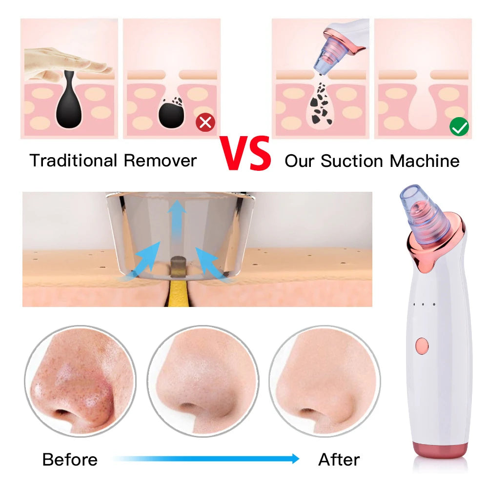 Professional ultra-fine bubble electric blackhead remover, facial vacuum cleaner, acne and pore extraction, facial cleansing, pe