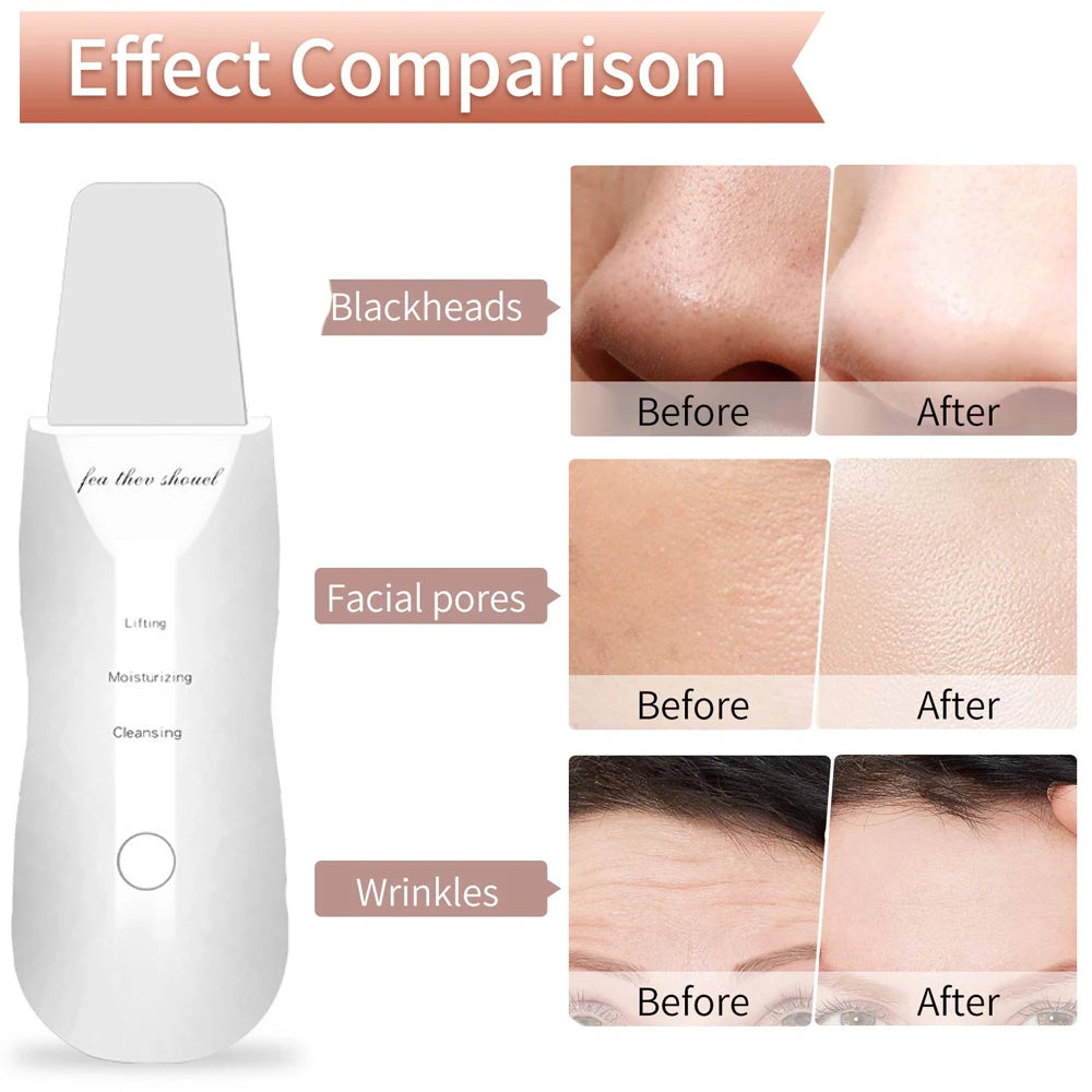 Ultrasonic Skin Scraper Peeling Blackhead Remover Deep Face Cleaning Lifting Acne Pore Cleaner Facial Spatula Shovel Cleanser