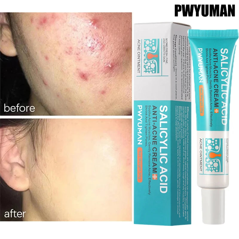 Salicylic Acid Acne Removal Cream Anti-Acne Repair Redness Pimple Spots Deep Cleaning Pore Oil Control Moisturizing Skin Care