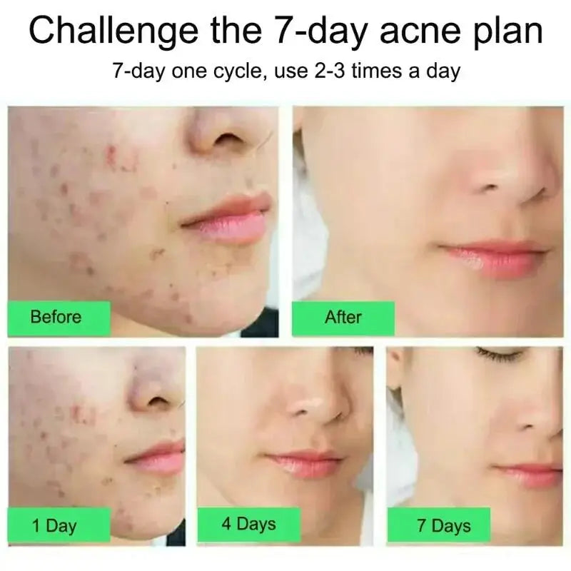 Salicylic Acid Acne Removal Cream Anti-Acne Repair Redness Pimple Spots Deep Cleaning Pore Oil Control Moisturizing Skin Care