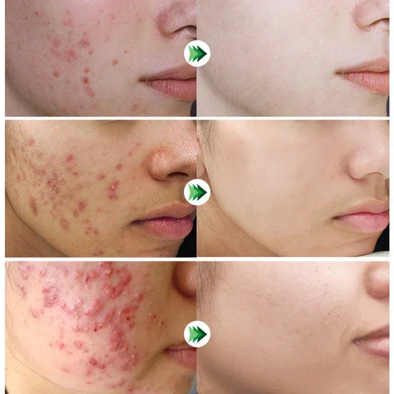 Salicylic Acid Acne Removal Cream Anti-Acne Repair Redness Pimple Spots Deep Cleaning Pore Oil Control Moisturizing Skin Care