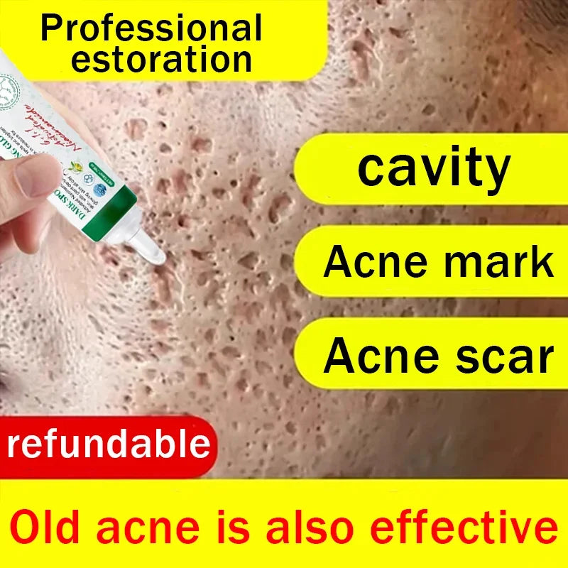 Pore Shrinking Cream Acne Pit Repair Product for Men Women Remove Acne Print Scar Large Pore Anti-inflammatory Smooth Skin Cream