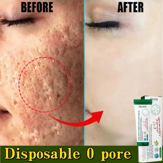 Pore Shrinking Cream Acne Pit Repair Product for Men Women Remove Acne Print Scar Large Pore Anti-inflammatory Smooth Skin Cream